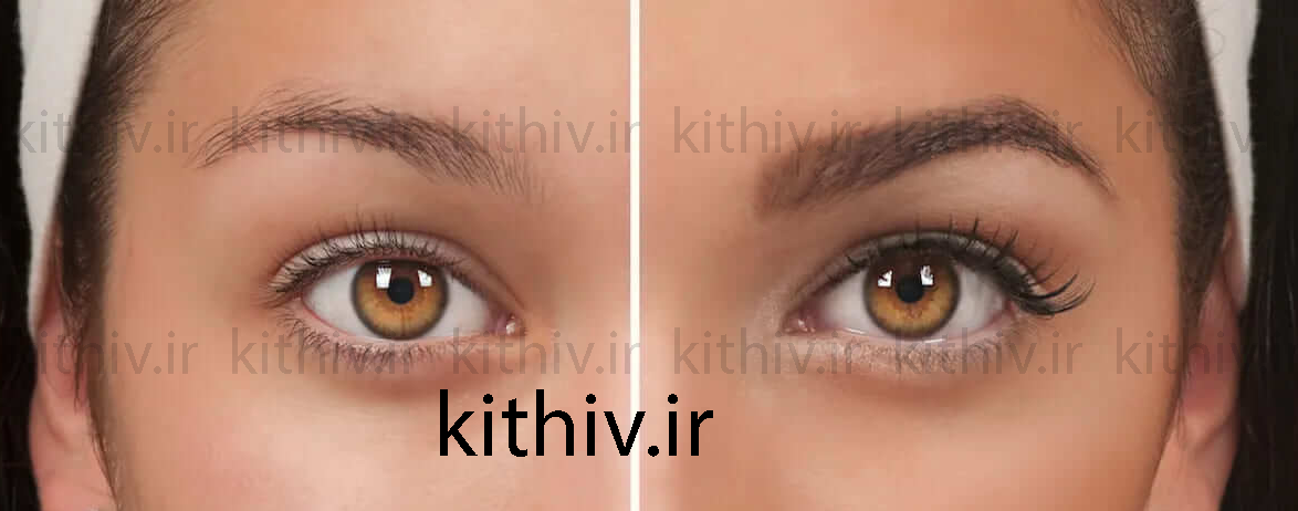 زیبایی بعد از کاشت