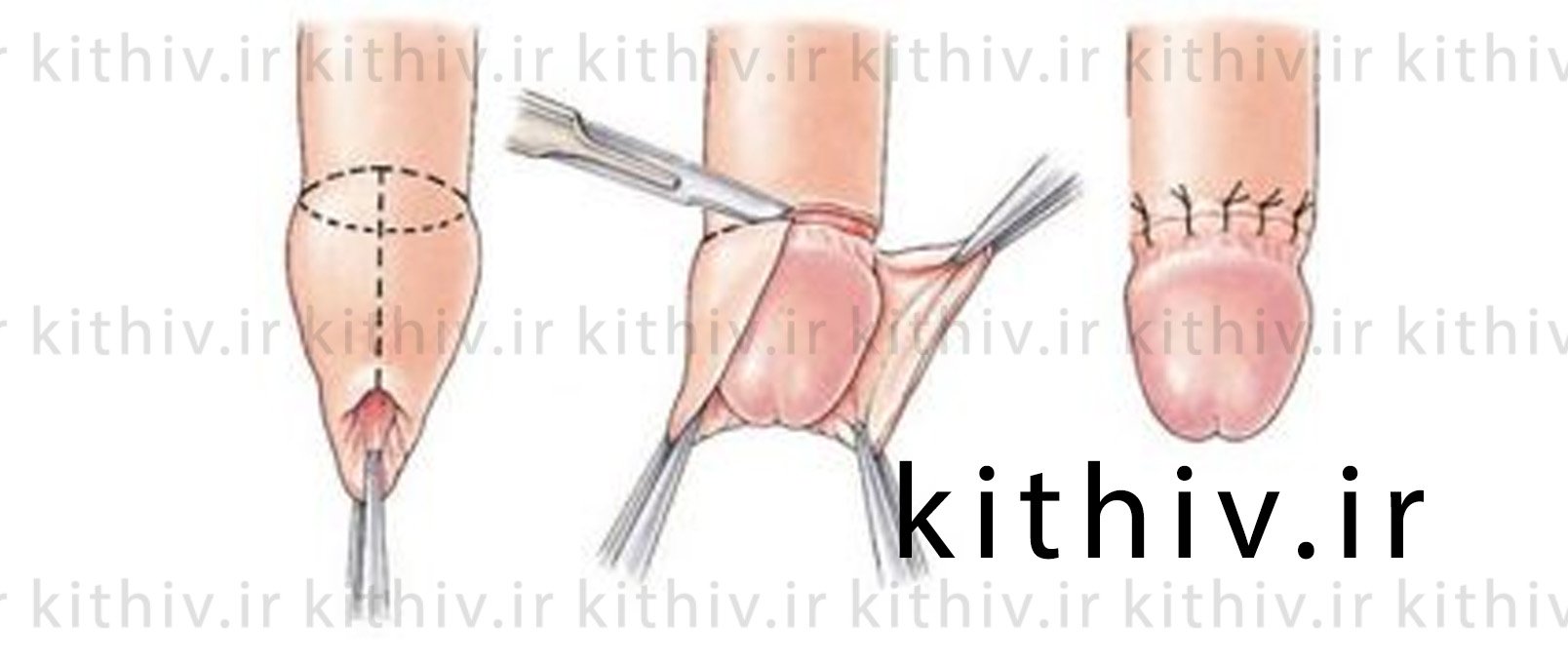 Male circumcision cosmetic surgery