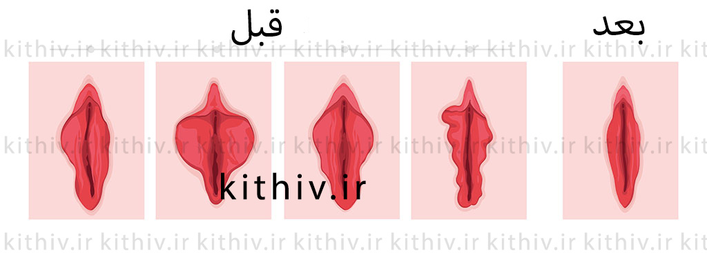 تصویر انواع فرم‌های لابیا قبل و بعد از عمل لابیاپلاستی. این جراحی با هدف اصلاح اندازه و شکل لبه‌های واژن، منجر به تقارن و زیبایی بیشتر ناحیه تناسلی می‌شود.