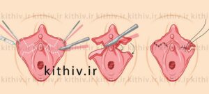 عمل زیبایی لابیاپلاستی