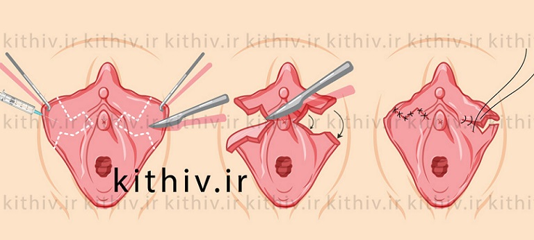 عمل زیبایی لابیاپلاستی