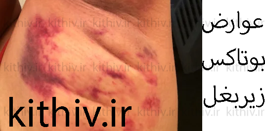 عوارض بوتاکس زیربغل