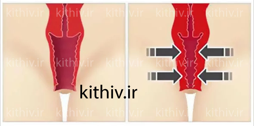 قبل و بعد از تزریق