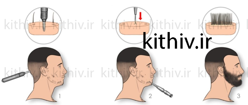 مراحل کاشت ریش