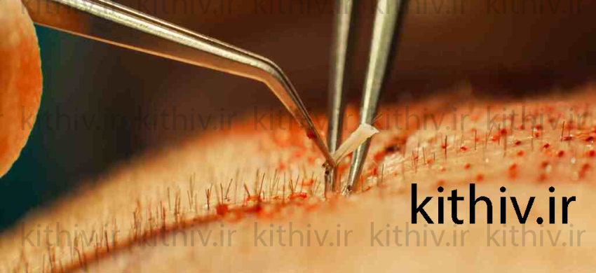 کاشت مو