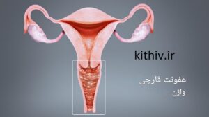 علائم عفونت قارچی واژن