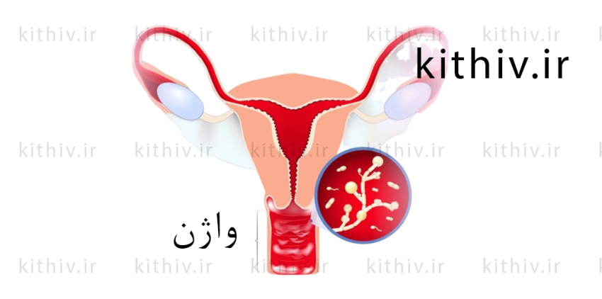 کاندیدیازیس واژینال